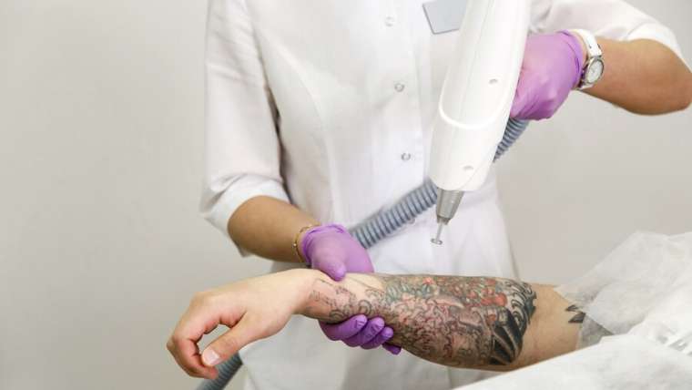 Safe and Affordable Laser Tattoo Removal in Surrey