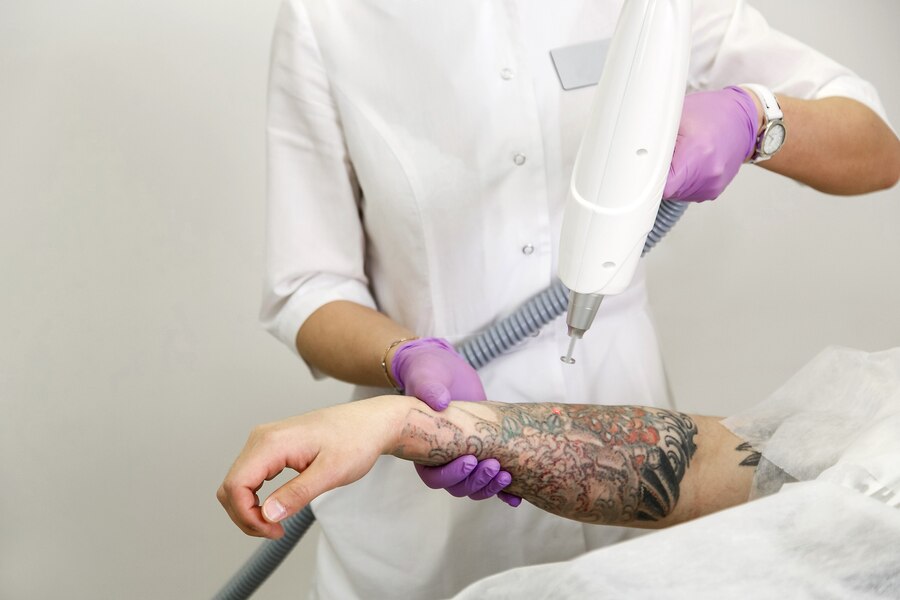 Safe and Affordable Laser Tattoo Removal in Surrey